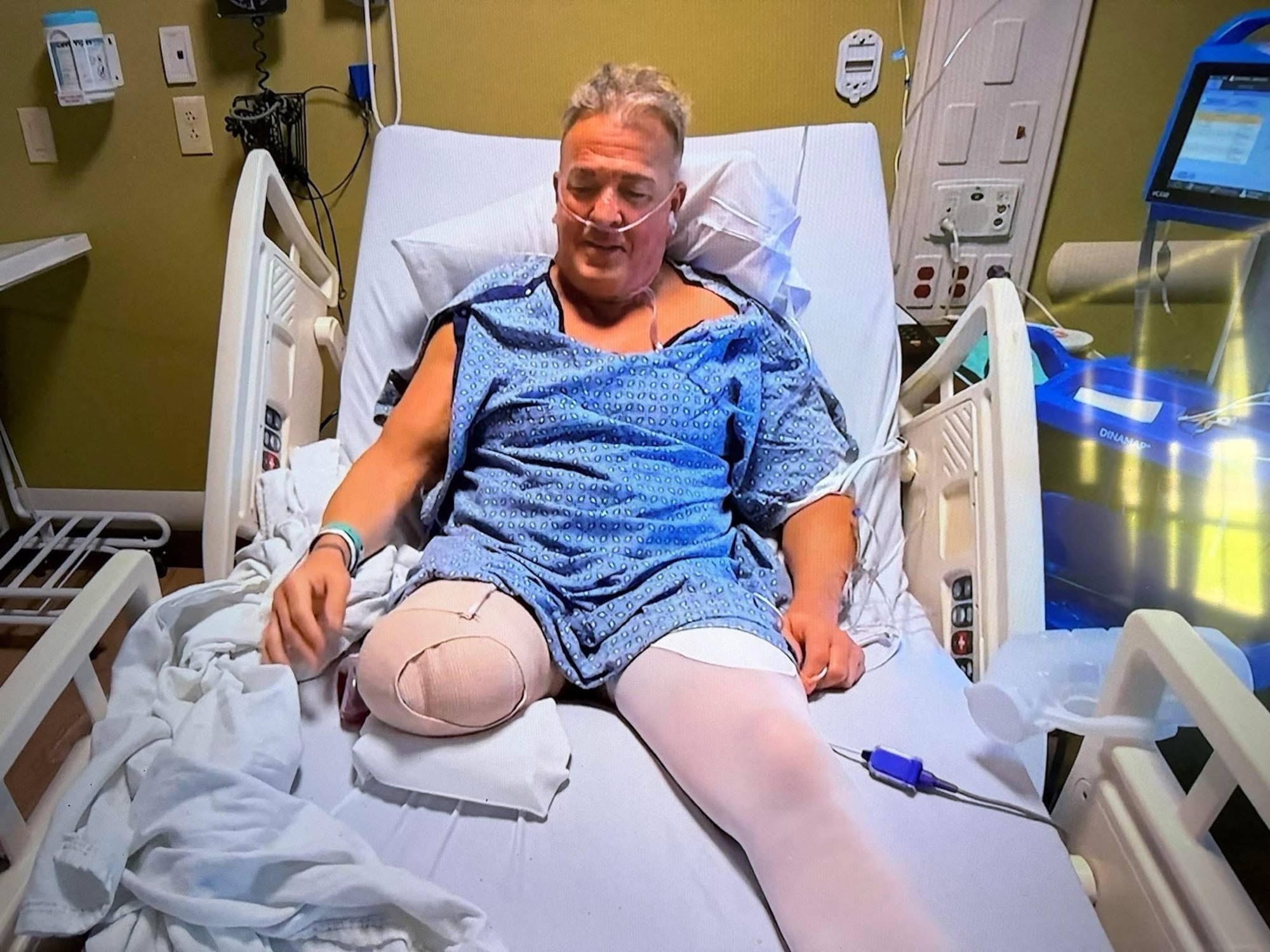 Marcus “Buff” Bagwell has leg amputated